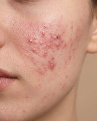 Acne-gevoelige huid