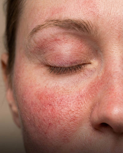 Rosacea-gevoelige huid